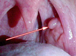 Papilloma sa larynx