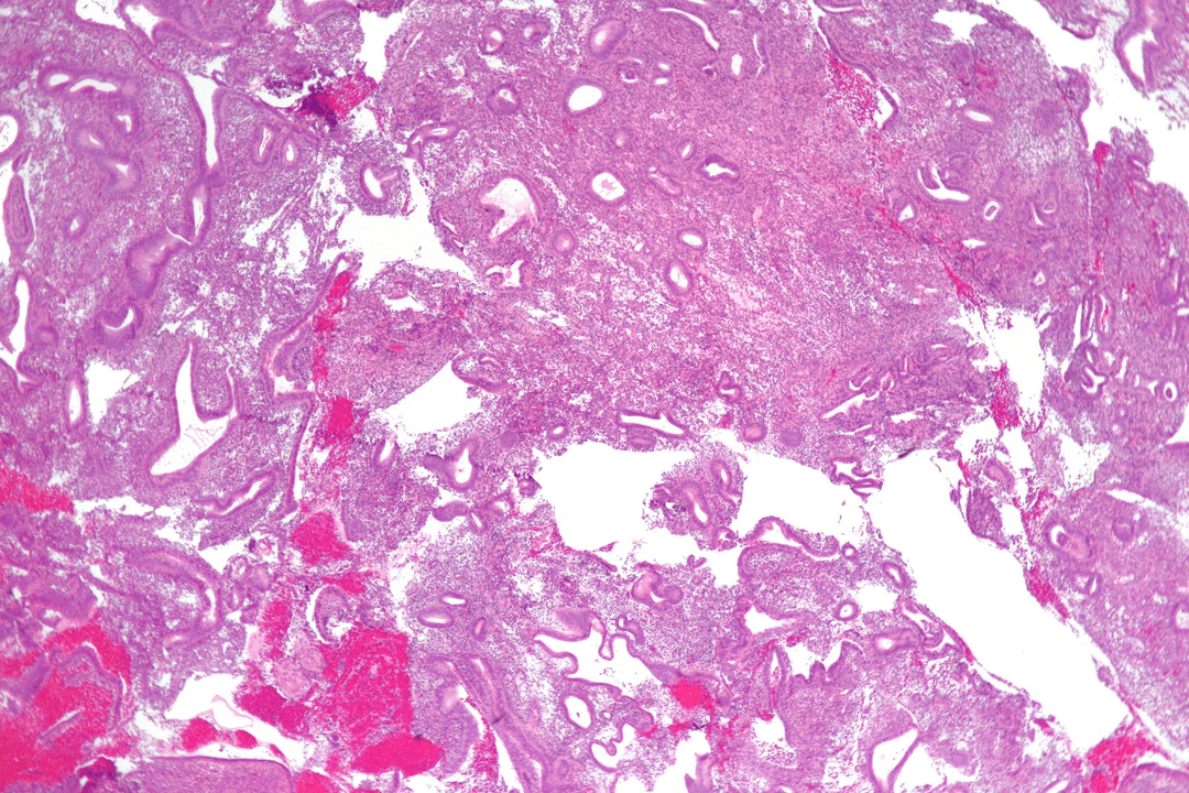 squamous cell papilloma